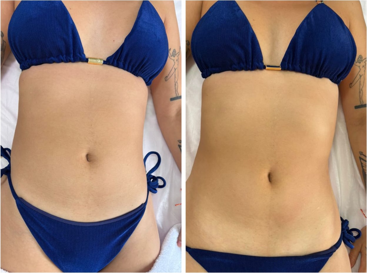 Drenagem Linfática — antes e depois, redução de inchaço abdominal