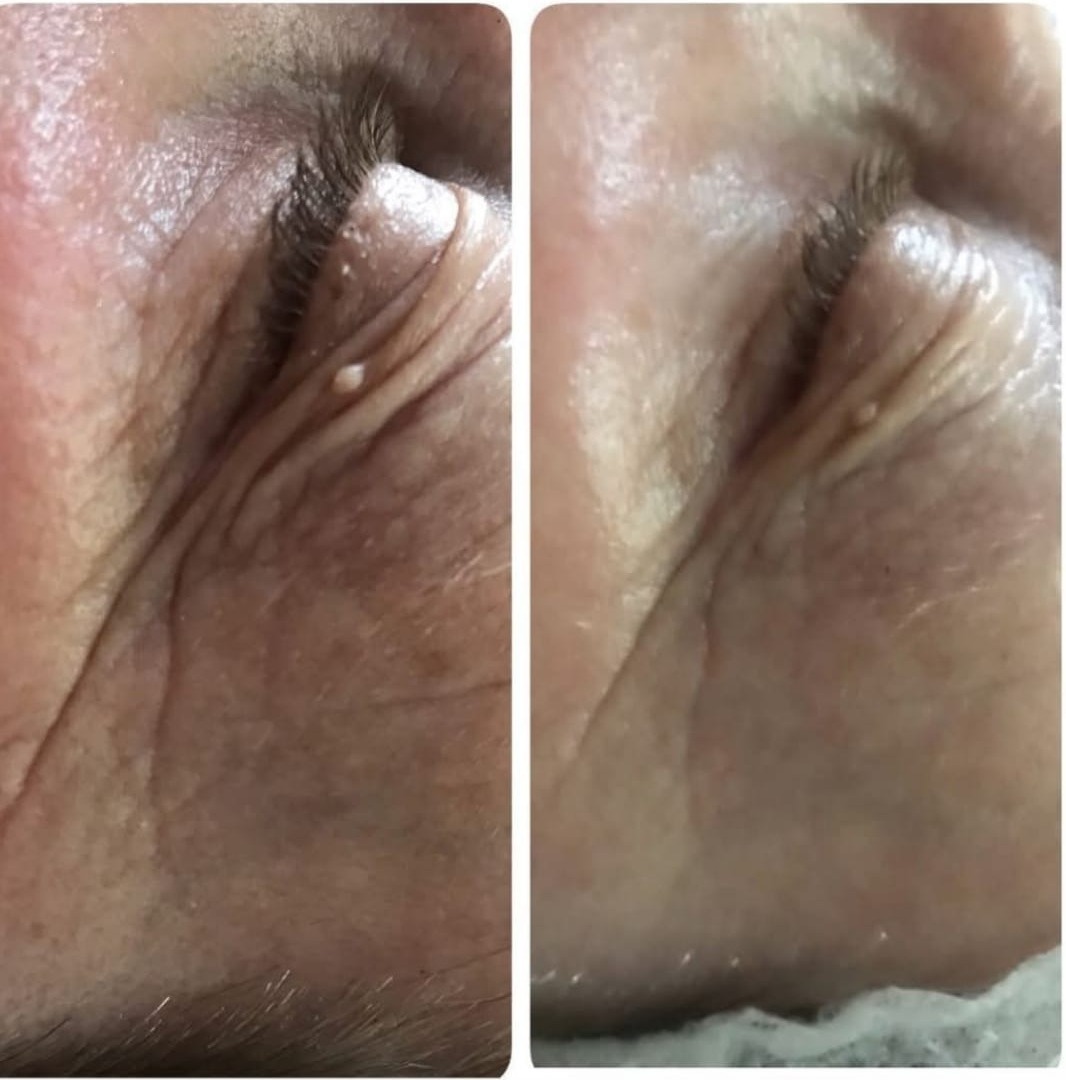 Micro-agulhamento — antes e depois, atenuação de rugas na área dos olhos